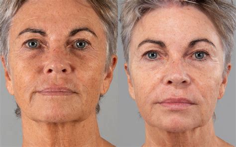 Stemform | Ansigtsbehandling