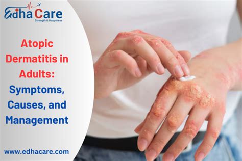 Atopic Dermatitis in Adults: Symptoms, and Effective Treatments