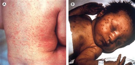 Congenital Rubella Syndrome Blueberry Muffin Rash