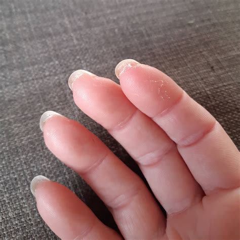 Fingernail Skin Peeling