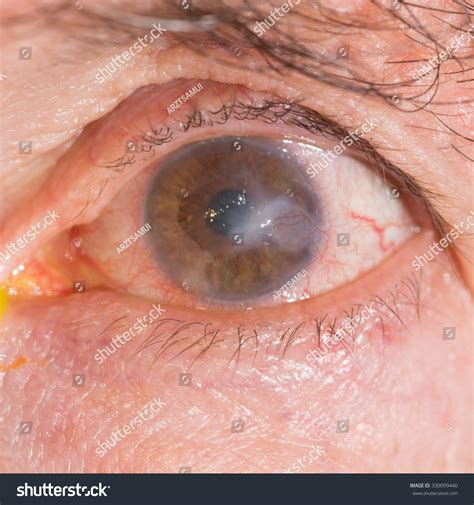 Interstitial Keratitis Diagnosis And Treatment – HHCT
