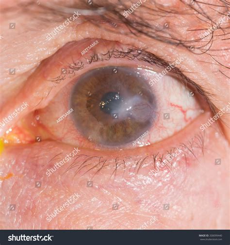 Close Interstitial Keratitis During Eye Examination Stock Photo 330099440 | Shutterstock