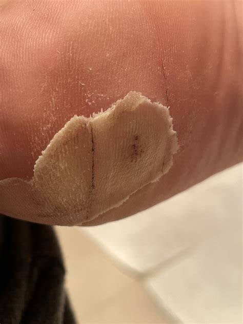 My heel… almost ready to peel the dead skin off! 💀 should I be scared