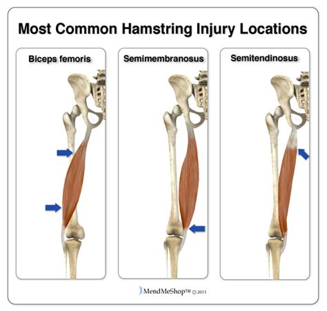 Tendinopathy of the Hamstring