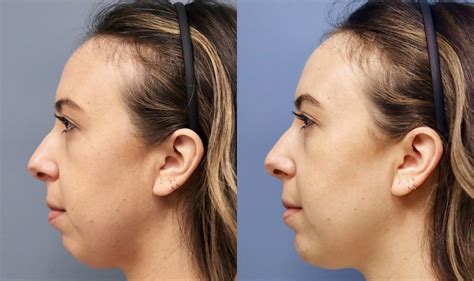 Chin Up! Non-Surgical Solutions for a Weak Chin - The District Injector