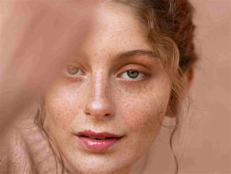 Melasma Treatment in Riyadh Only in 399 SAR