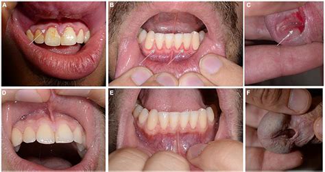 Mucous Membrane Pemphigoid Mild