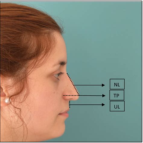Nose Nerve Block