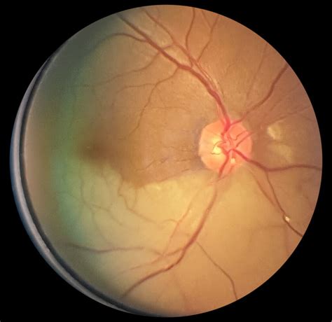 Abnormal fundoscopic appearances | OSCEstop | OSCE Learning