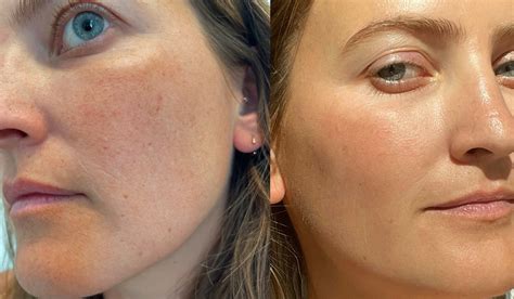 I Got a Laser Treatment For Broken Capillaries: See Photos | PS Beauty