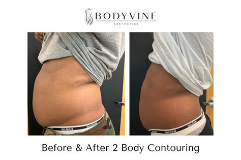 Body Contouring Treatments - Body Vine Aesthetics