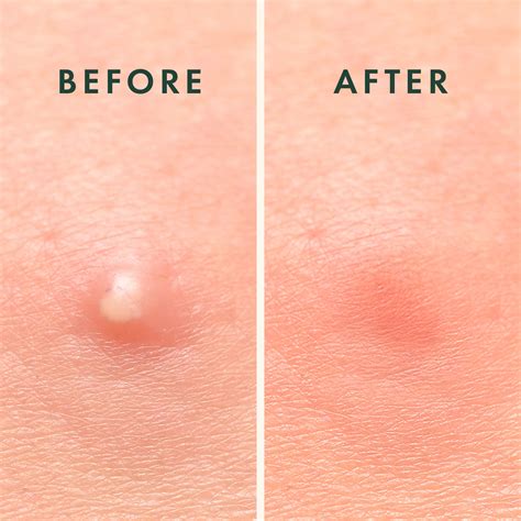 How to Use Acne Patch: Clear Skin Quickly! - Best blackheadremoval