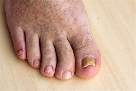 Toenail Problems: Ingrown, Fungal and Thickened Nail Treatement