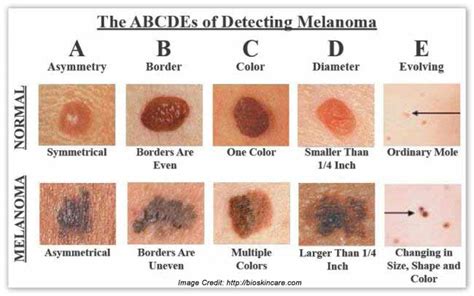 melanoma skin cancer  symptoms treatment global treatment