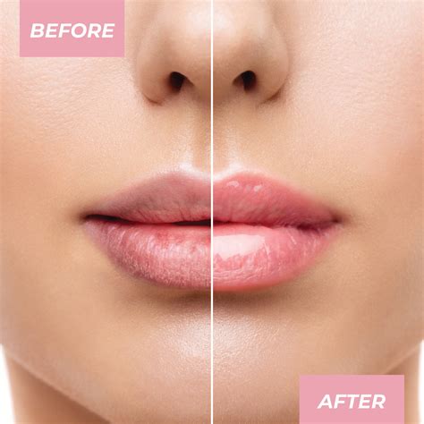 This simple trick for blackheads on lip line works overnight for many 3