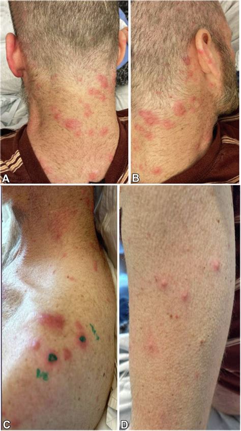 Sweets Syndrome Dual Diagnosis Of Histiocytoid Sweet Syndrome And