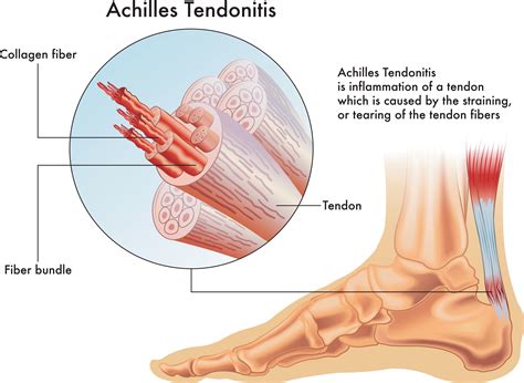 symptoms-of-achilles-tendonitis-and-physiotherapy | Simply Align Rehab