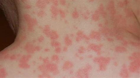 allergic reaction rash pictures rashes    blotches welts