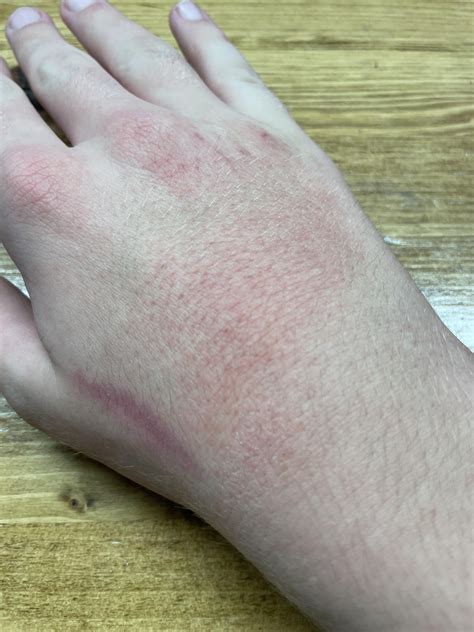 My cat scratched me a very small amount yesterday and now my hands are