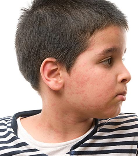 Eczema In Children - Causes, Symptoms And Treatment