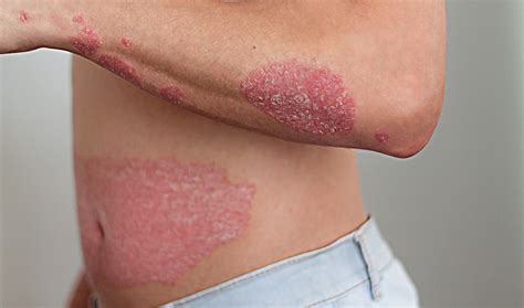 psoriasis family health diary