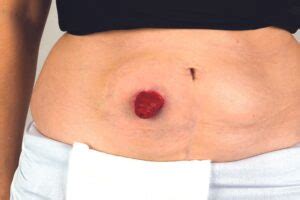 urostomy urostomy association