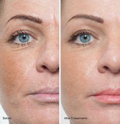 Prp Rosto Antes E Depois - 7 ideias de Prp facial | microagulhamento rosto, microagulhamento antes ...