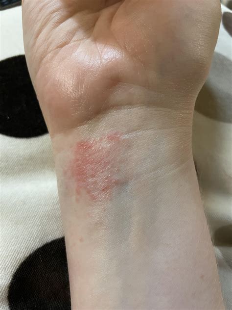 Does this look like just atopic dermatitis? : r/DermatologyQuestions