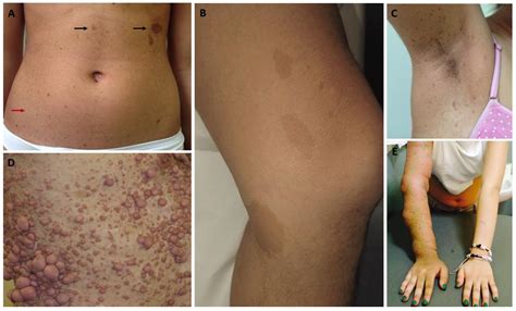 Neurofibromatosis Type 1: Pediatric Aspects and Review of Genotype ...