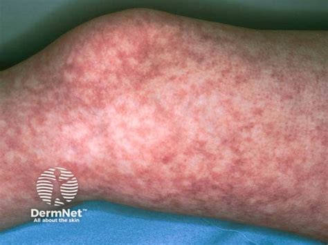 sjogren syndrome image