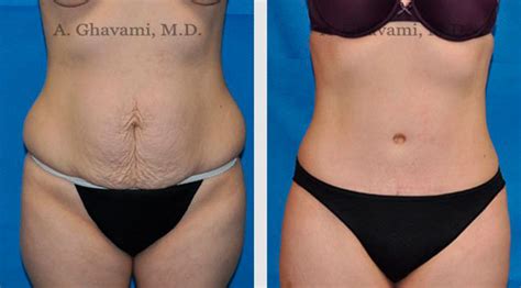 Como Fica A Barriga Depois Da Abdominoplastia - Abdominoplastia - fotos preço antes e depois