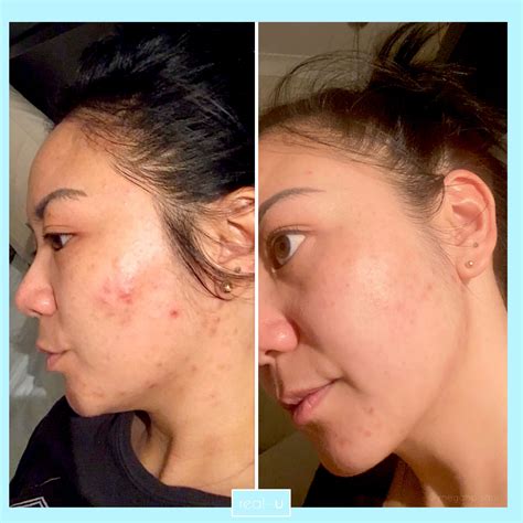 Unbelievable Blackhead Removal 2024: The Results Are Absolutely Stunning. Image 10