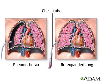 Pneumothorax - series—Incision: MedlinePlus Medical Encyclopedia