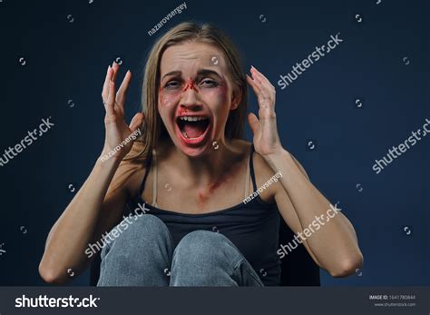 young girl bleeding face covered bruises stock photo