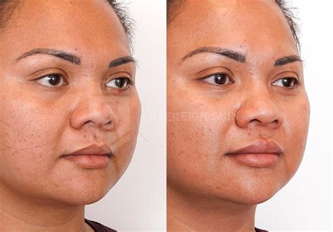 Lip Filler Before & After Gallery at Sovereign Skin in Toronto