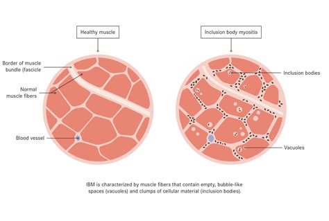 Inclusion Body Myositis - Treatment and Symptoms - AUTOIMMUNE SISTERS