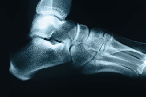 Foot Xray - Foundation for Orthopaedic Research and Education (FORE)