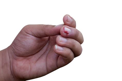 how to remove ingrown fingernail at home
