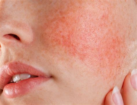 dermatologists guide  rosacea top dos donts prequel