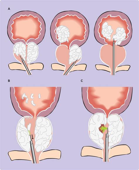 Benign Prostatic Hypertrophy Surgery