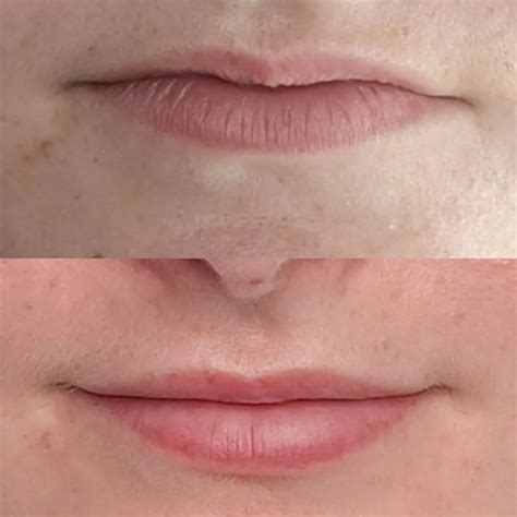 The Art of Lip Filler Injections: Finding a Skilled Practitioner