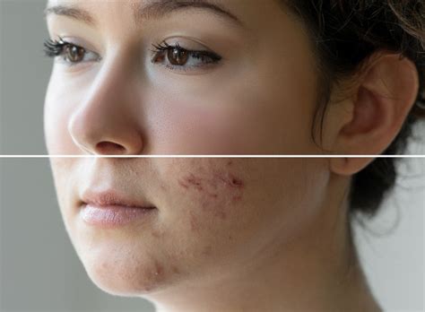acne vulgaris dermatology associates