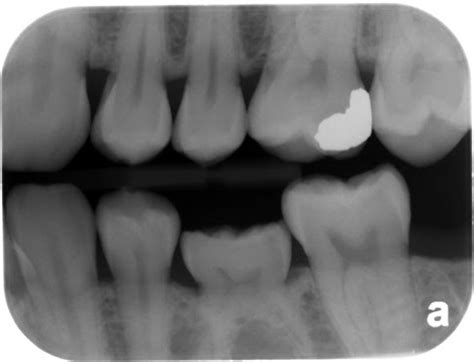 Hypodontia-missing teeth, baby teeth, spaces, implants, orthodontics ...