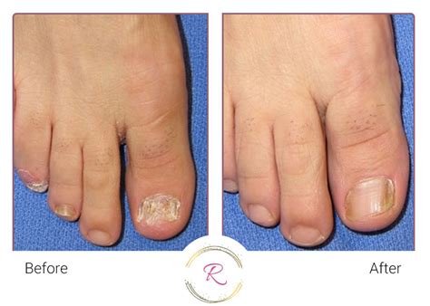 nail fungus treatment  albia iowa  alma lasers