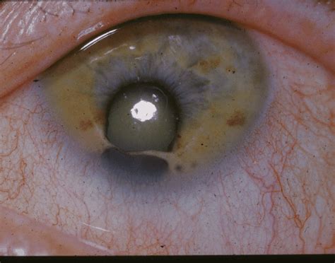 Coloboma - Wikipedia