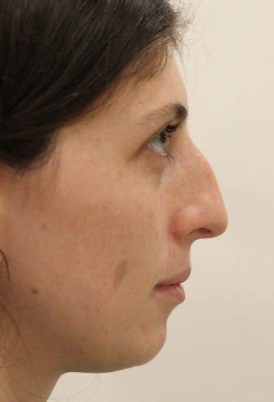Deviated Septum Repair Before & After Photos | Klausner Institute