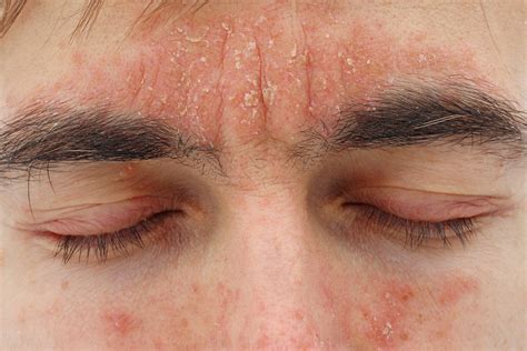 Como Se Escreve Parece - Seborrheic Dermatitis - Integrity Skin