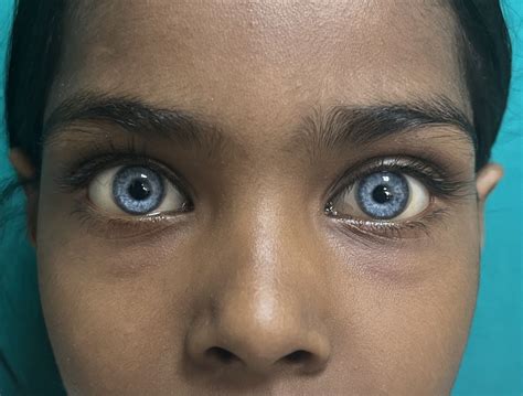Waardenburg Syndrome Symptoms Pictures Causes And Treatment