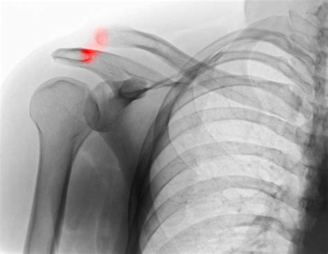 Separated Shoulder or an Injury to the AC Joint