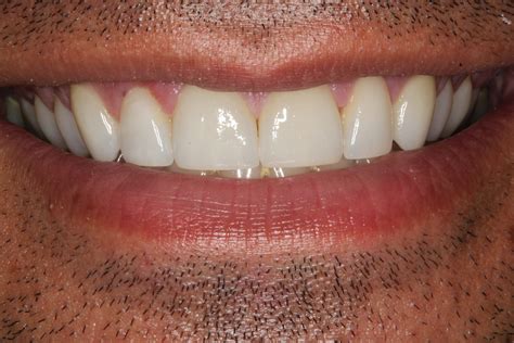 Case Study on Using Veneers to Fix Gap in Front Teeth